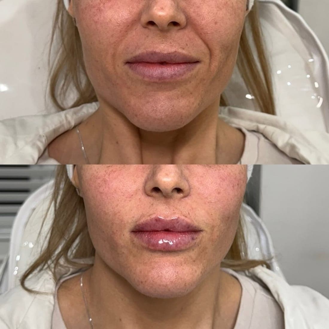 Lips and lower face, before above and after below