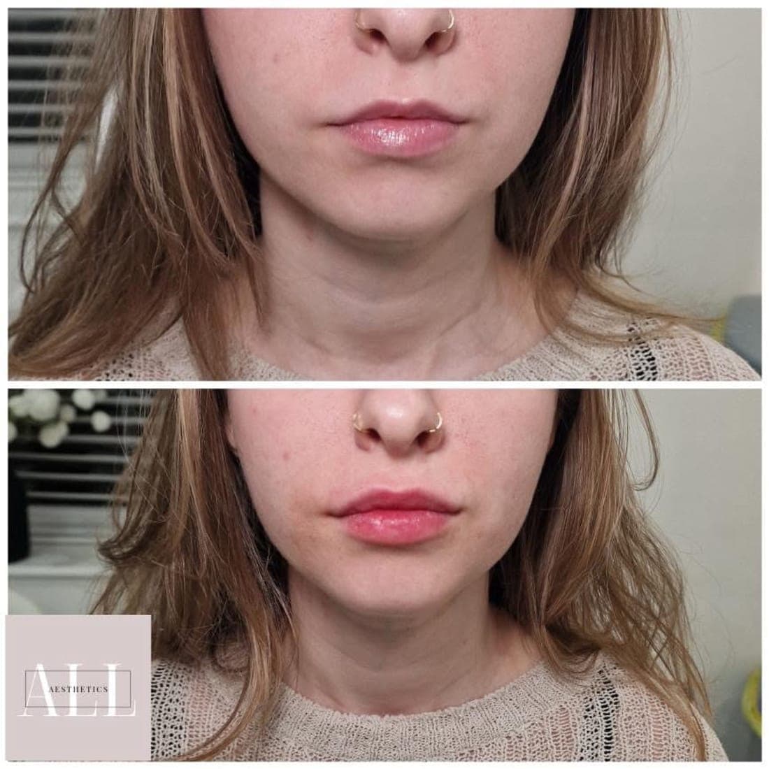 Lips front view, before above and after below, hair down
