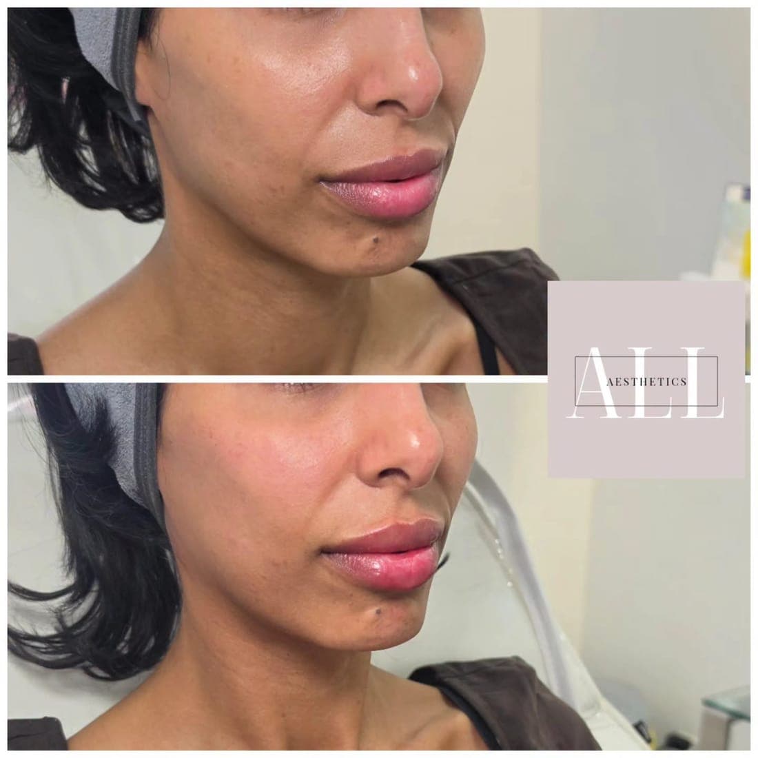 Lips at an angle, before above and after below