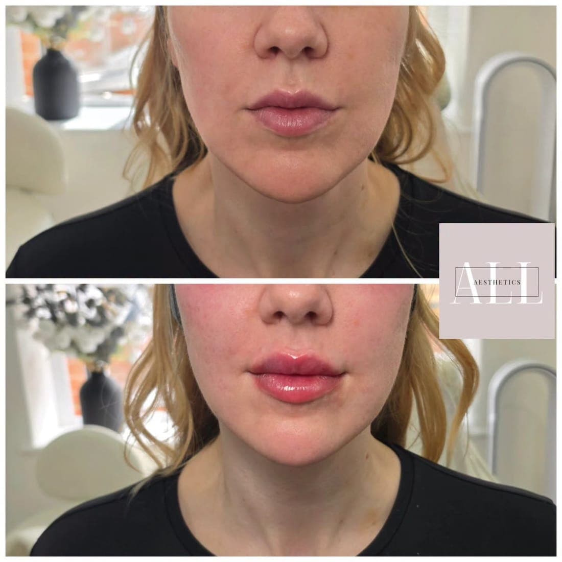 Lips front view, before above and after below, black top