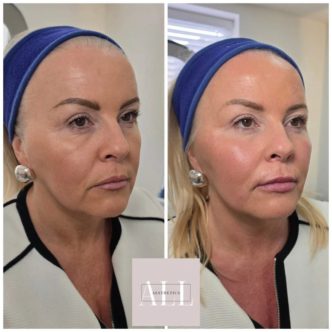 Face at three quarters, before and after side by side, blue headband