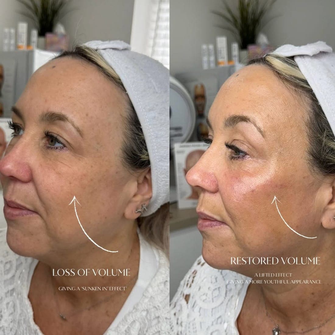 Side profile before and after, marked loss of volume and restored volume