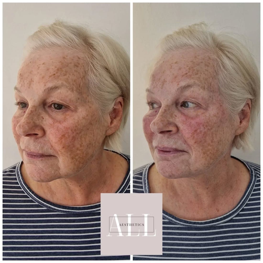 Skin before and after, face at an angle, striped top