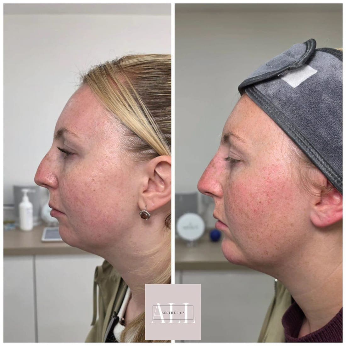 Skin in side profile, before and after, calmer after