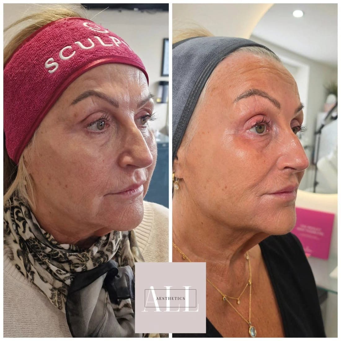 Face and skin at an angle, before and after side by side