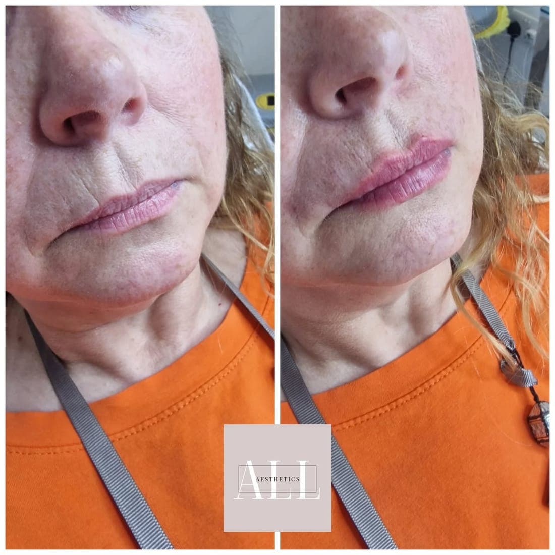Upper lip lines close up, before and after side by side