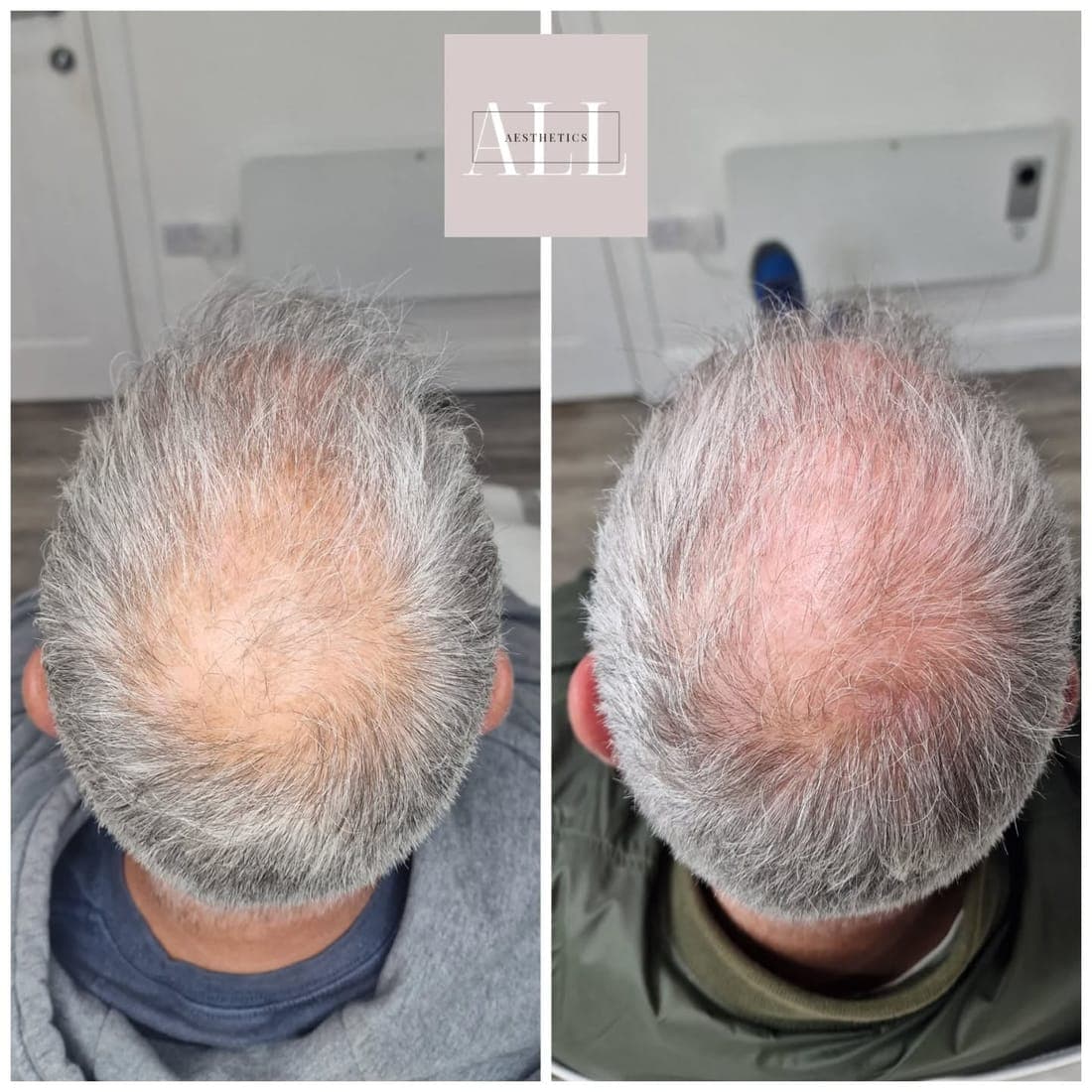 Scalp from above, before and after side by side