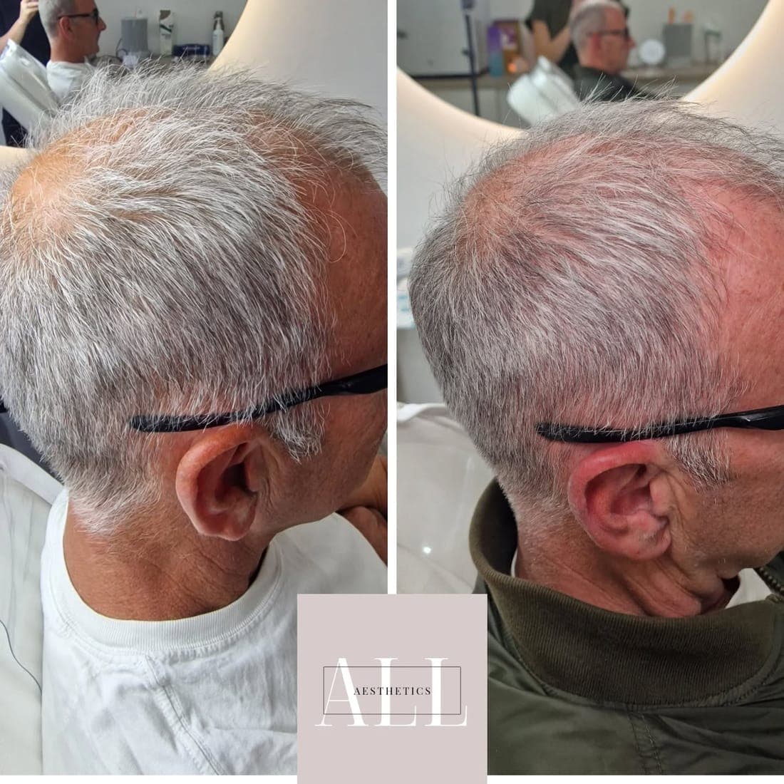 Scalp from the side, before and after side by side