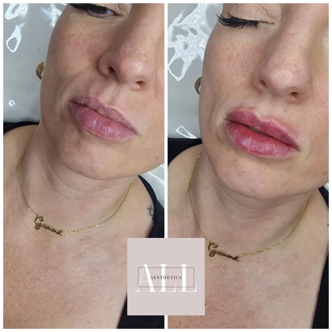 Lips before and after, side by side, fuller and smoother after, one of Amy's clients