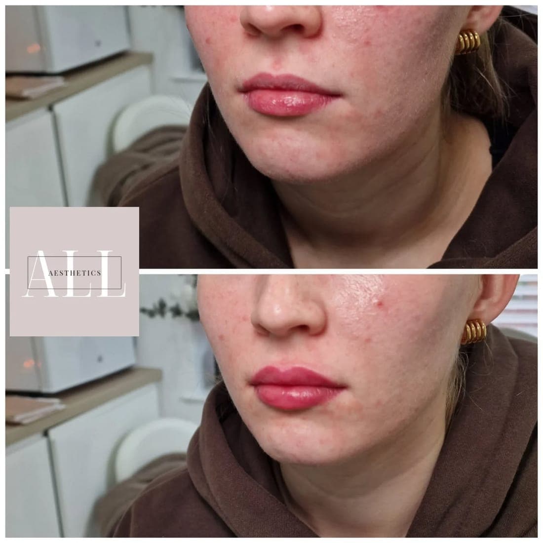 Lips front view, before above and after below, one of Amy's clients
